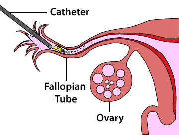 Gamete Intra Fallopian Tube Transfer Fertility First of Fertility First 50-52 Gloucester Rd - Photo 3 of 4