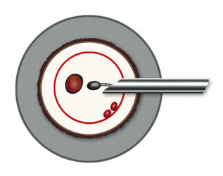 Intracytoplasmic sperm Injection Fertility First of Fertility First 50-52 Gloucester Rd - Photo 4 of 4