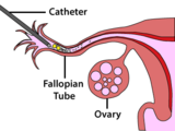Gamete Intra Fallopian Tube Transfer, Fertility First, Hurstville