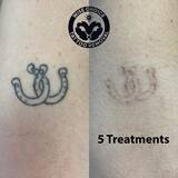 Profile Photos of Wise Choice Tattoo Removal