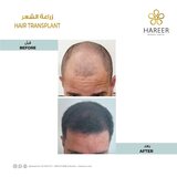  Hareer Dermatology Clinic The Iridium Building, Umm Suqeim St, Al Barsha, Al Barsha 1 