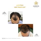  Hareer Dermatology Clinic The Iridium Building, Umm Suqeim St, Al Barsha, Al Barsha 1 