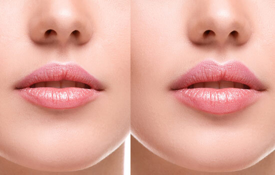 Lip Augmentation Services of Wellsprings Medical Spa 11685 Yonge Street, Unit 101A & 102A - Photo 1 of 4