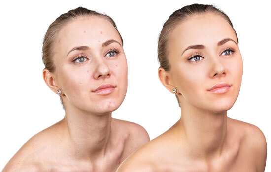 Acne Treatment Services of Wellsprings Medical Spa 11685 Yonge Street, Unit 101A & 102A - Photo 4 of 4