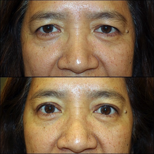  Profile Photos of The Center for Eye and Facial Plastic Surgery in Livingston - Dr. Deepak Ramesh 22 Old Short Hills Road, Suite 202 - Photo 2 of 3