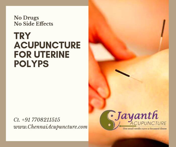 Acupuncture Treatment For Uterine Polyps in Chennai Acupuncture Treatment in Annanagar of Chennai Jayanth Acupuncture Clinic Vasantham Colony, Annanagar, - Photo 10 of 27
