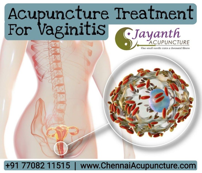 Acupuncture Treatment For Vaginitis - Vaginal Infection in Chennai Acupuncture Treatment in Annanagar of Chennai Jayanth Acupuncture Clinic Vasantham Colony, Annanagar, - Photo 9 of 27 Acupuncture Treatment For Vaginitis - Vaginal Infection in Chennai Acupuncture Treatment in Annanagar of Chennai Jayanth Acupuncture Clinic Vasantham Colony, Annanagar, - Photo 9 of 27