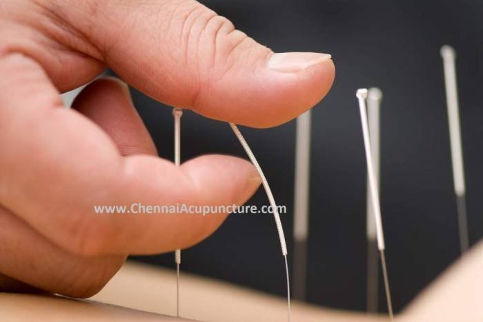 Acupuncture Treatment in chennai - Acupuncture Doctor Profile Photos of Chennai Jayanth Acupuncture Clinic Vasantham Colony, Annanagar, - Photo 2 of 2 Acupuncture Treatment in chennai - Acupuncture Doctor Profile Photos of Chennai Jayanth Acupuncture Clinic Vasantham Colony, Annanagar, - Photo 2 of 2