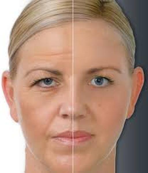  Profile Photos of Botox and Dermal FillersÂ  NI 14 Ballymoney Road, Ballymena, Co Antrim - Photo 6 of 7