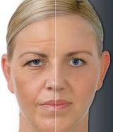 Botox and Dermal FillersÂ  NI, Ballymena, Co Antrim