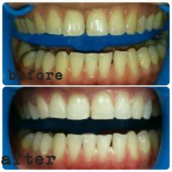  Profile Photos of Hsmile Teeth Whitening & Dental Hygiene 10376 Yonge Street, unit 202 - Photo 2 of 4