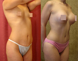 Cosmetic Surgery in Delhi, India, delhi