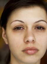 blepharitis treatment for itchy eyes Dry Eyes Clinic 1 Granville Avenue 