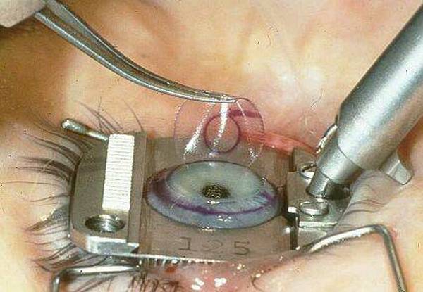  Profile Photos of Best Lasik Eye Surgery in Mumbai, India | Eye Care Hospital Raghu Kamal Hospital, Anthshil 66, Marve Road, Orlem, Above Dena Bank, Malad (W) - Photo 1 of 1