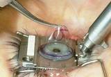 Best Lasik Eye Surgery in Mumbai, India | Eye Care Hospital, Mumbai