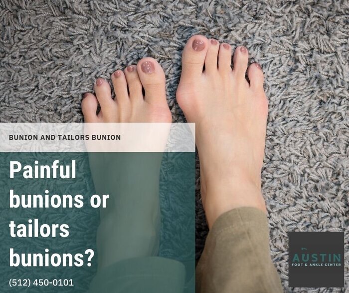 <br />
Painful bunions or tailors bunions? https://www.linkedin.com/company/austin-foot-&-ankle-center New Album of Austin Foot & Ankle Center 9012 Research Blvd #C13 - Photo 10 of 18 <br />
Painful bunions or tailors bunions? https://www.linkedin.com/company/austin-foot-&-ankle-center New Album of Austin Foot & Ankle Center 9012 Research Blvd #C13 - Photo 10 of 18