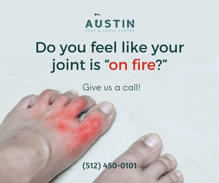 Do you feel like your joint is on fire? Call your Austin foot specialist about arthritis. https://austin-footdoctor.blogspot.com<br />
New Album of Austin Foot & Ankle Center 9012 Research Blvd #C13 - Photo 15 of 18 Do you feel like your joint is on fire? Call your Austin foot specialist about arthritis. https://austin-footdoctor.blogspot.com<br />
New Album of Austin Foot & Ankle Center 9012 Research Blvd #C13 - Photo 15 of 18