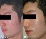 Hair Transplant Doctors in Delhi, Delhi