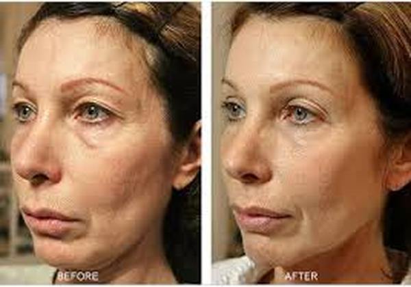 Profile Photos of Thermage Skin Tightening Treatment in Delhi 37 Pocket-1  Jasola Nr Apollo Hospital New Delhi-110025 - Photo 3 of 3