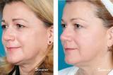 Thermage Skin Tightening Treatment in Delhi, Delhi