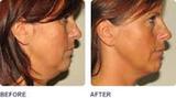 Thermage Skin Tightening Treatment in Delhi, Delhi