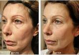 Thermage Skin Tightening Treatment in Delhi, Delhi