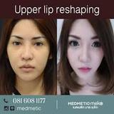 Lips Reshaping, Delih