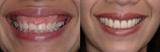Lips Reshaping, Delih