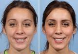 Lips Reshaping, Delih