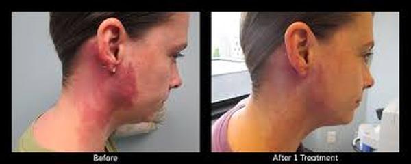  Profile Photos of Birthmark Removal Cost 37 Pocket-1  Jasola Nr Apollo Hospital New Delhi-110025 - Photo 1 of 5