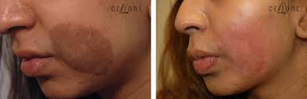  Profile Photos of Birthmark Removal Cost 37 Pocket-1  Jasola Nr Apollo Hospital New Delhi-110025 - Photo 2 of 5