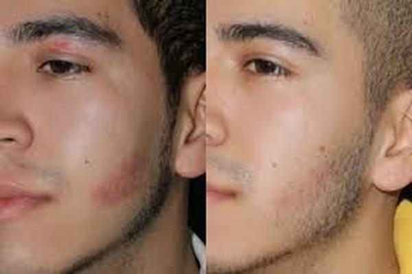  Profile Photos of Birthmark Removal Cost 37 Pocket-1  Jasola Nr Apollo Hospital New Delhi-110025 - Photo 3 of 5