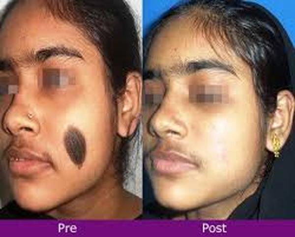  Profile Photos of Birthmark Removal Cost 37 Pocket-1  Jasola Nr Apollo Hospital New Delhi-110025 - Photo 4 of 5