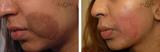 Birthmark Removal Cost, Delhi