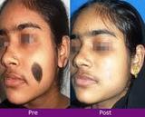 Birthmark Removal Cost, Delhi