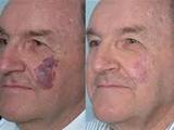 Birthmark Removal Cost, Delhi