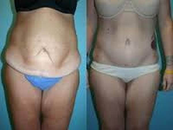  Profile Photos of Liposuction in Delhi 37 Pocket-1  Jasola Nr Apollo Hospital New Delhi-110025 - Photo 2 of 5