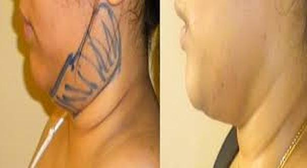  Profile Photos of Liposuction in Delhi 37 Pocket-1  Jasola Nr Apollo Hospital New Delhi-110025 - Photo 4 of 5