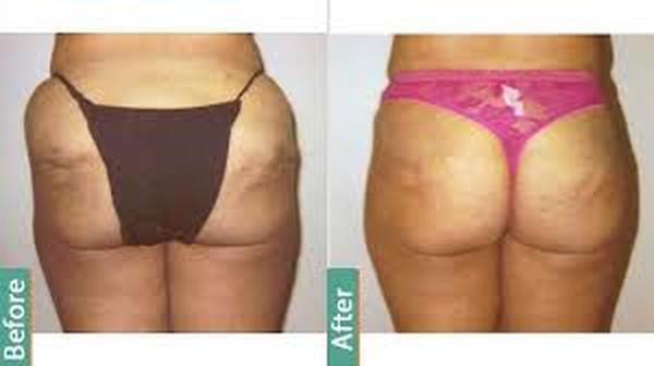  Profile Photos of Liposuction in Delhi 37 Pocket-1  Jasola Nr Apollo Hospital New Delhi-110025 - Photo 5 of 5