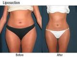  Liposuction in Delhi 37 Pocket-1  Jasola Nr Apollo Hospital New Delhi-110025 