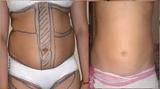 Liposuction in Delhi, Delhi