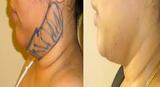 Liposuction in Delhi, Delhi