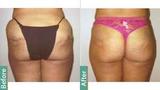 Liposuction in Delhi, Delhi