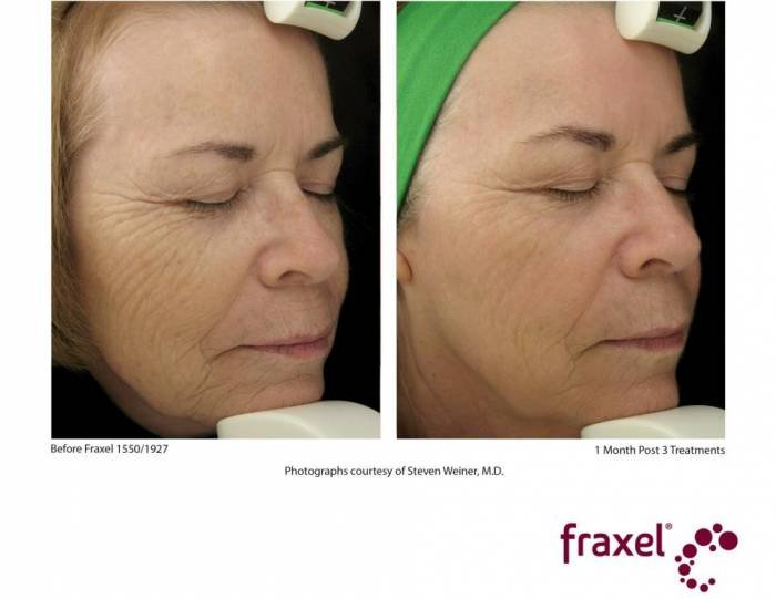 Fraxel CLCI Procedures of Cosmetic Laser Center of Irvine 15775 Laguna Canyon Rd. Suite 270 - Photo 17 of 17