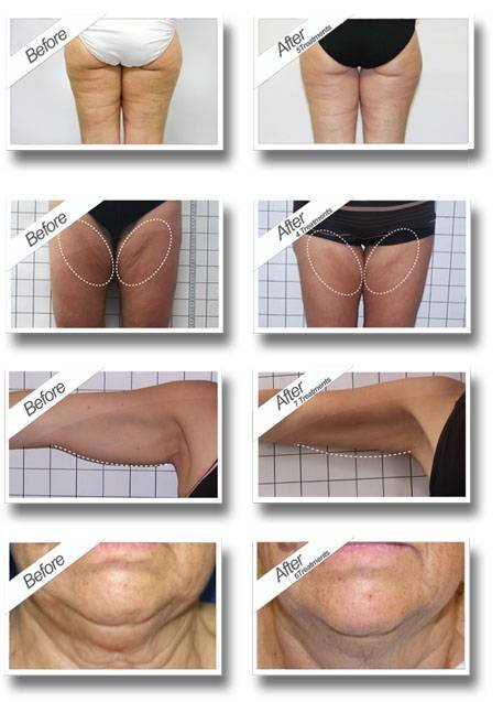 Venus Freeze CLCI Procedures of Cosmetic Laser Center of Irvine 15775 Laguna Canyon Rd. Suite 270 - Photo 15 of 17
