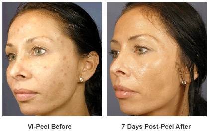 Vi Peel (Chemical Peel) CLCI Procedures of Cosmetic Laser Center of Irvine 15775 Laguna Canyon Rd. Suite 270 - Photo 14 of 17