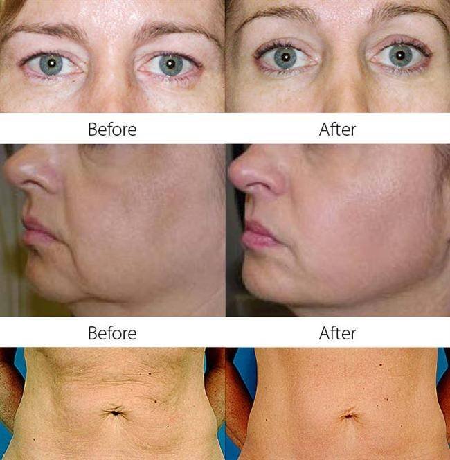 Thermage CLCI Procedures of Cosmetic Laser Center of Irvine 15775 Laguna Canyon Rd. Suite 270 - Photo 16 of 17