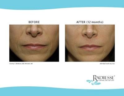 Radiesse - Filler CLCI Procedures of Cosmetic Laser Center of Irvine 15775 Laguna Canyon Rd. Suite 270 - Photo 13 of 17