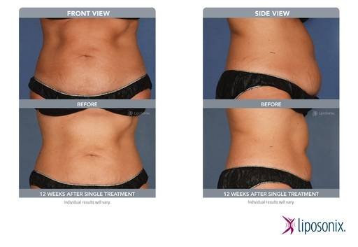 Liposonix CLCI Procedures of Cosmetic Laser Center of Irvine 15775 Laguna Canyon Rd. Suite 270 - Photo 11 of 17