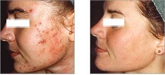 Isolaz CLCI Procedures of Cosmetic Laser Center of Irvine 15775 Laguna Canyon Rd. Suite 270 - Photo 9 of 17